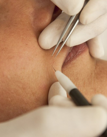 İğneli Epilasyon İzmir | Pakalın Güzellik